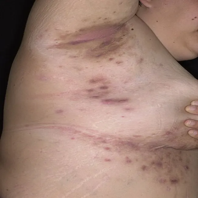 Trądzik odwrócony pod piersią