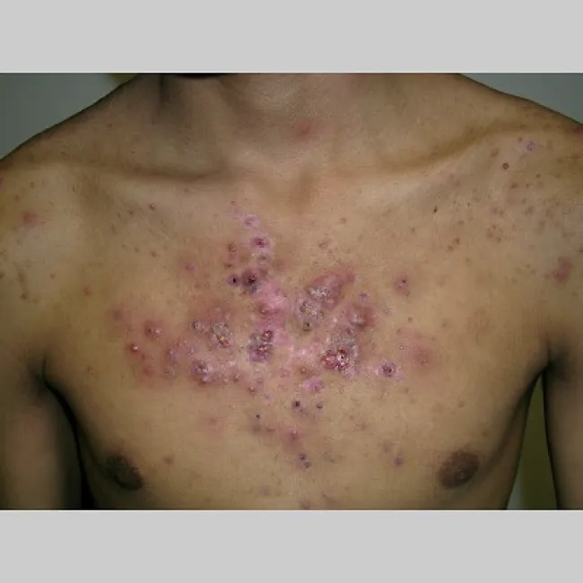 Trądzik piorunujący na klatce piersiowej