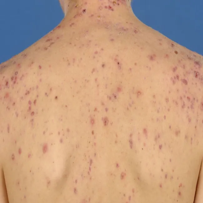 Trądzik piorunujący