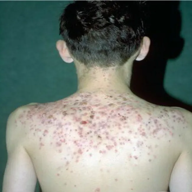 Trądzik skupiony na plecach