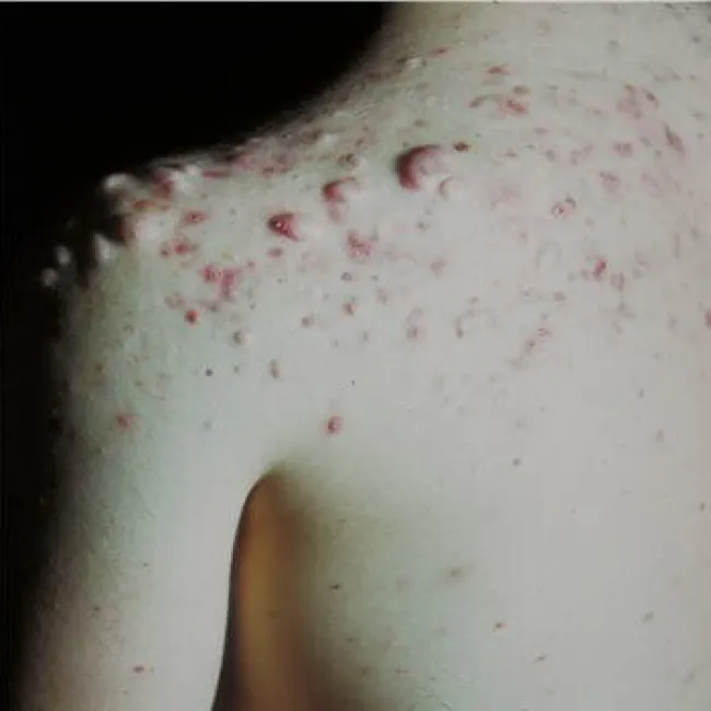 Trądzik skupiony objawy