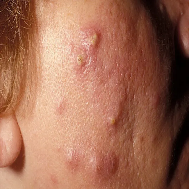 Trądzik skupiony wygląd