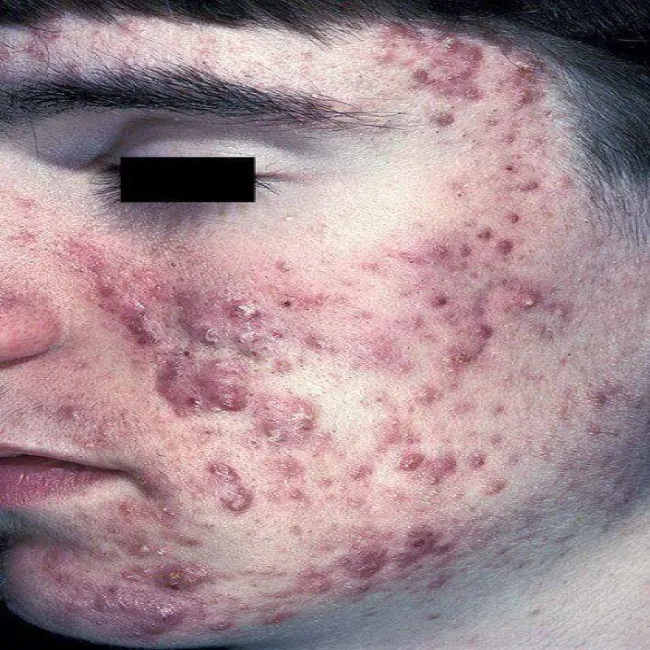 Trądzik skupiony wykwity na twarzy