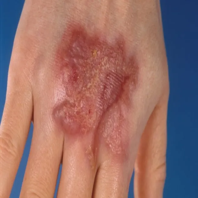 Trudno gojące się rany na dłoniach piodermia zgorzelinowa