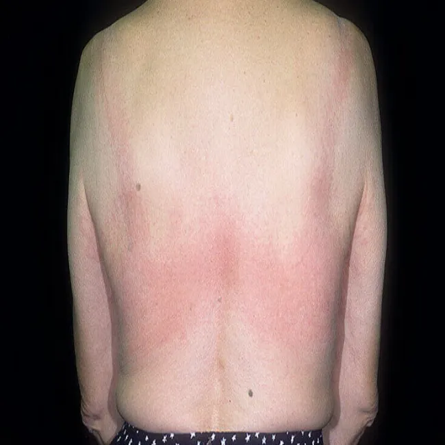 Uczulenie na biustonosz lateksowy