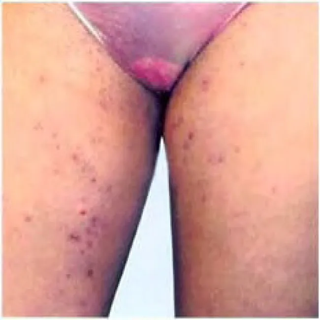 Uda zapalenie mieszków włosowych