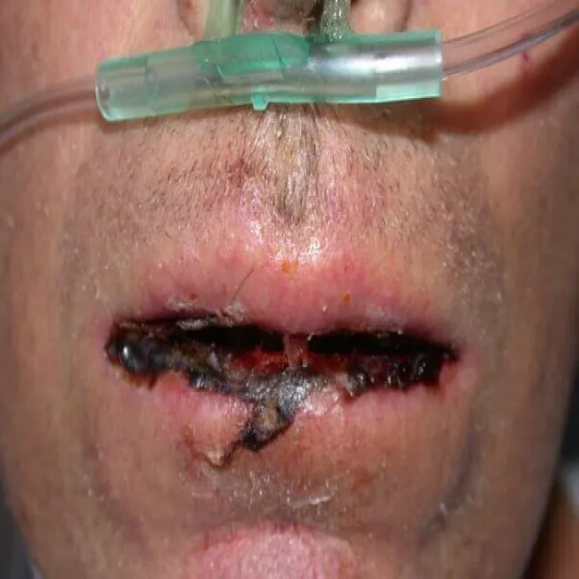 Usta choroba zespół Stevensa- Johnsona