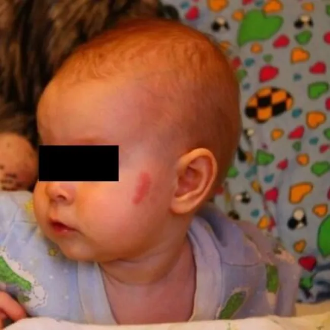 Uszczypnięcie bociana czerwone znamię na twarzy