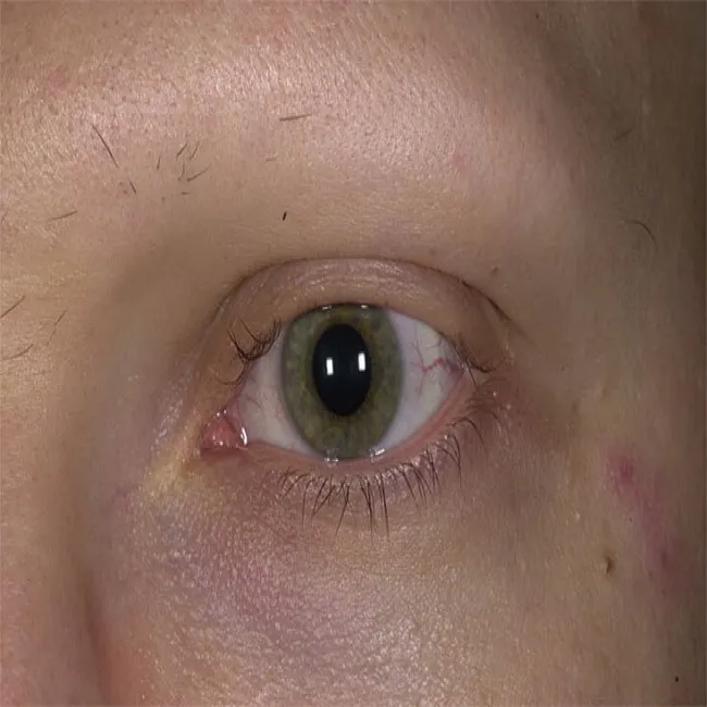 Utrata brwi i rzęs łysienie plackowate