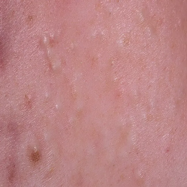 Wągry na skórze zdjęcie