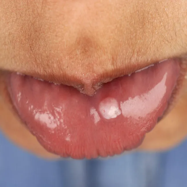 Włókniak na ustach