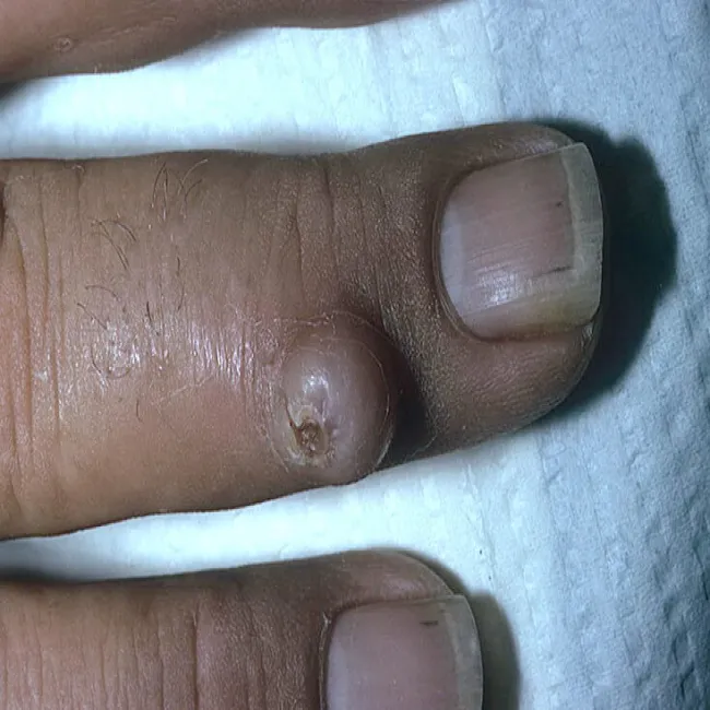 Włókniak twardy na palcu