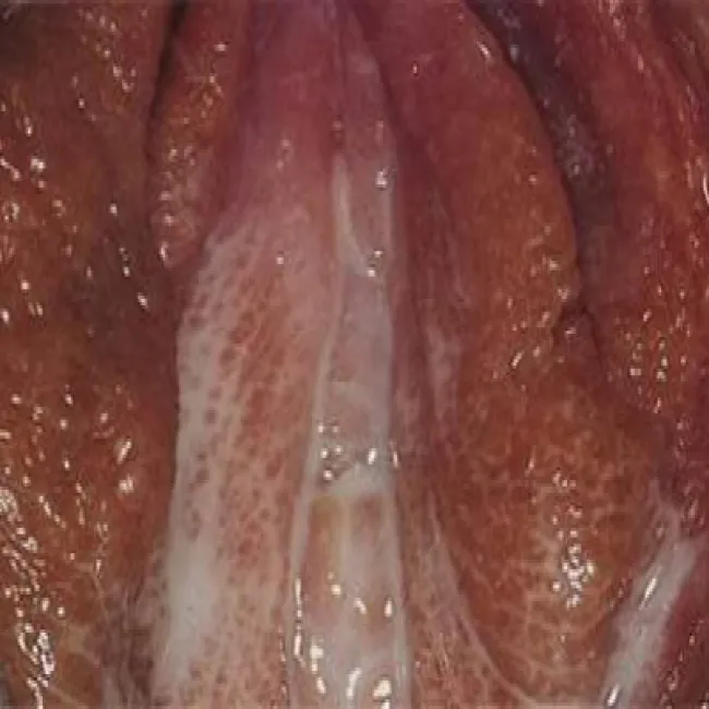 Wargi sromowe choroby zdjęcia rzeżączka