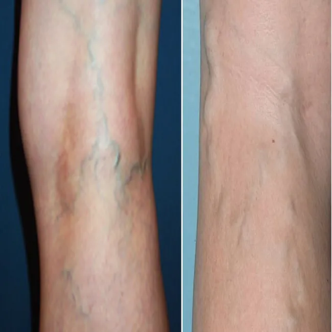 Widoczne niebieskie żyły na nogach