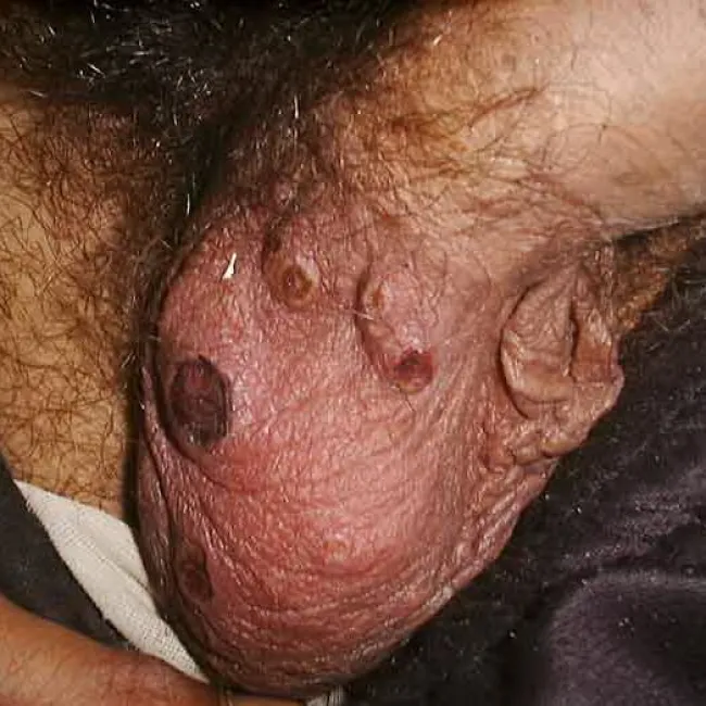 Worek mosznowy zdjęcia choroba Behçeta 