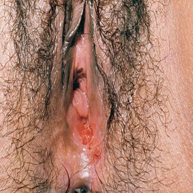 Wrzód weneryczny warg sromowych