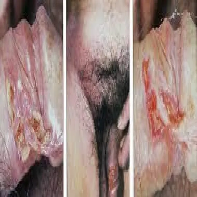 Wrzód-weneryczny zdjęcie