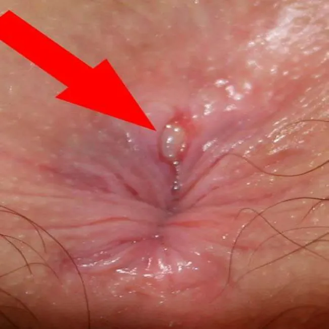 Wstydliwe choroby odbytu szczelina odbytu 