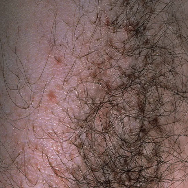 Wszawica łonowa u kobiet objawy