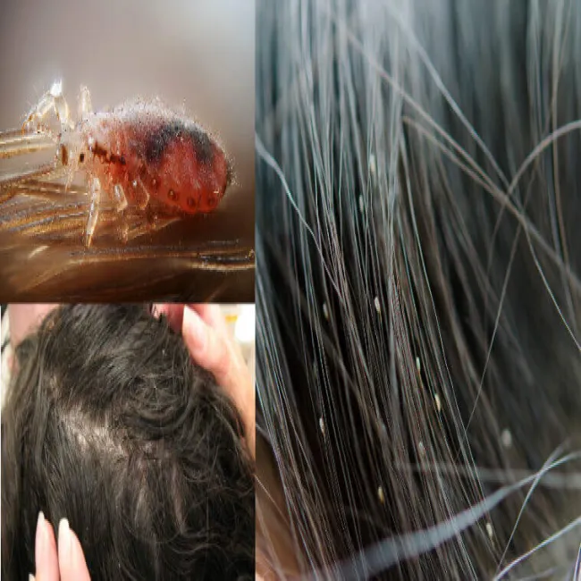 Wszy u dziecka jak rozpoznać