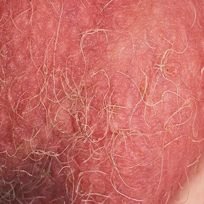 Wszy w miejscach intymnych