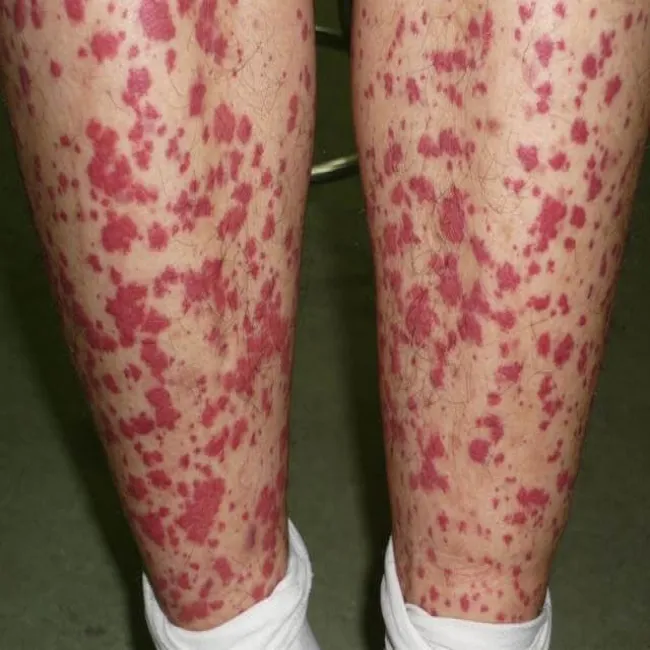 Wybroczyny na nogach małopłytkowość immunologiczna