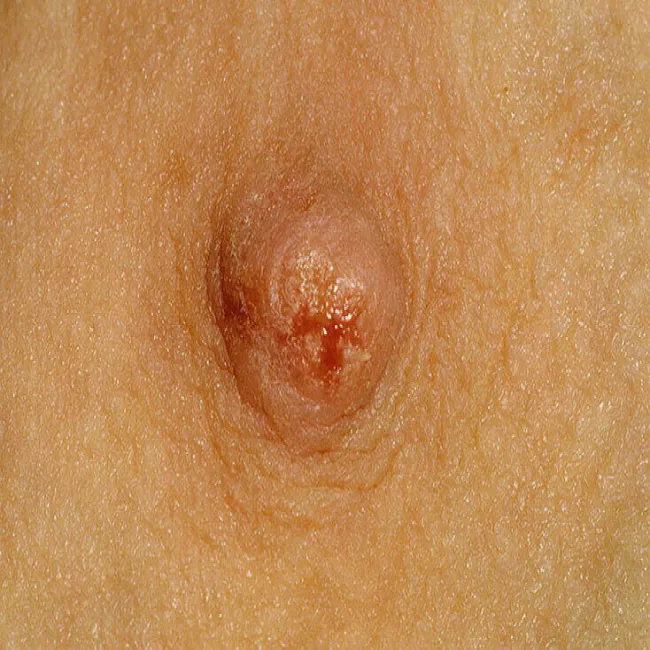 Wyciek z brodawki sutkowej