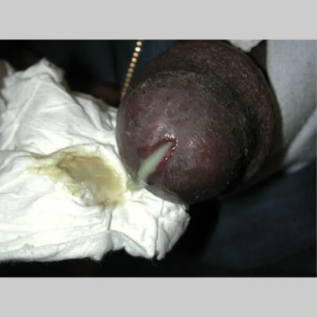 Wydzielina z cewki moczowej u mężczyzn choroba rzeżączka