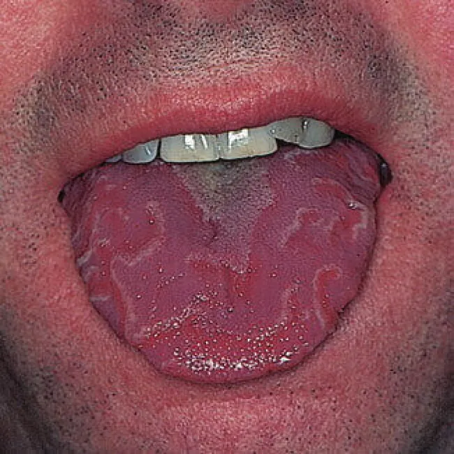 Wygląd języka objaw języka geograficznego