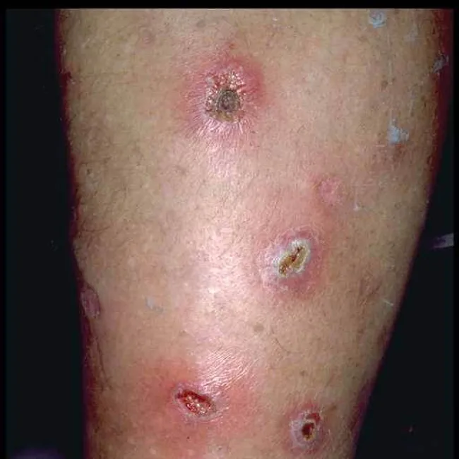 Wykwity pęcherzykowo-krostkowe na podłożu rumieniowym ecthyma 