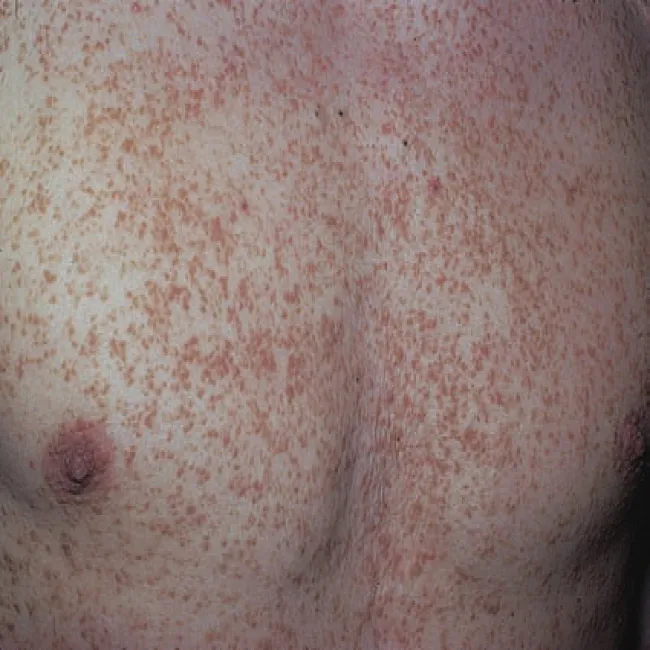 Wykwity skórne na klatce piersiowej choroba Dariera