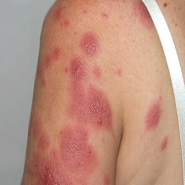 Wykwity skórne na ramieniu 