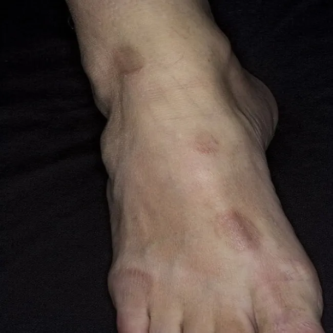 Wykwity skórne na stopie ziarniniak obrączkowaty 