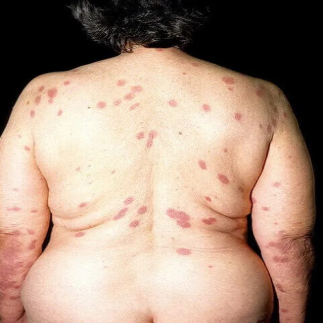 Wykwity skórne zespół Sweeta 