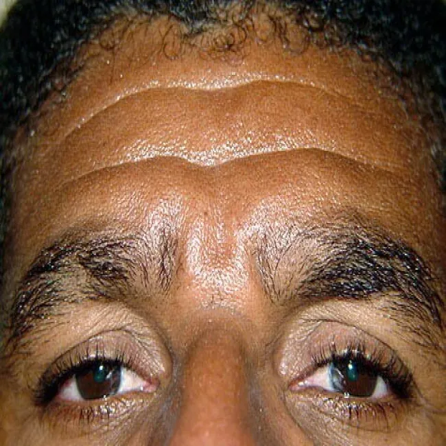 Wypadanie brwi u mężczyzn łysienie plackowate