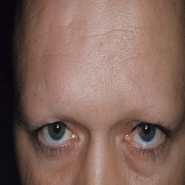 Wypadanie włosów rzęs i brwi przyczyny łysienie plackowate