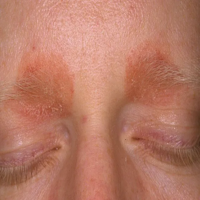 Wyprysk łojotokowy brwi