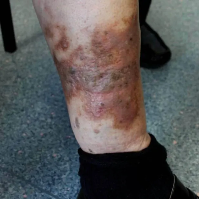 Wyprysk żylakowy podudzi