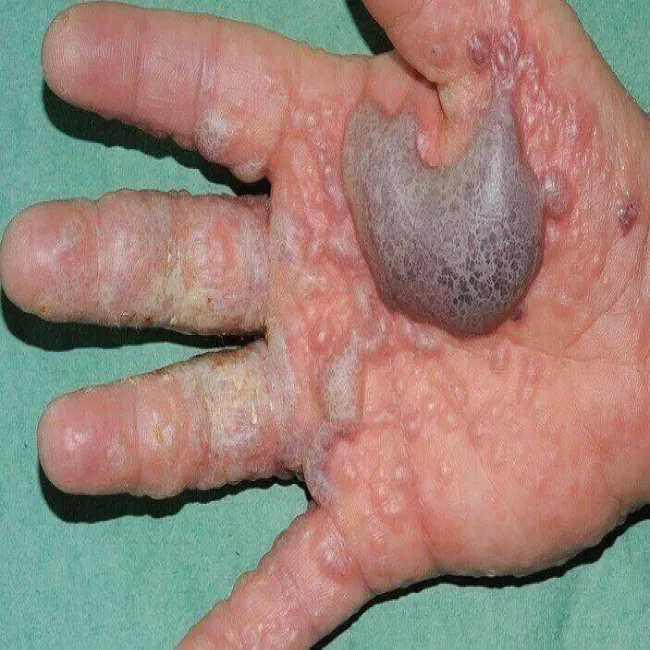 Wyprysk dyshidrotyczny dłoni