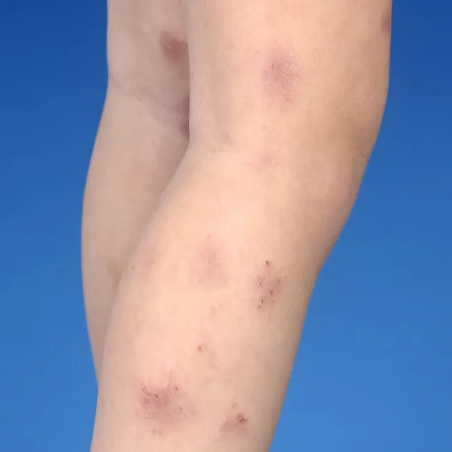 Wyprysk pieniążkowaty na nodze