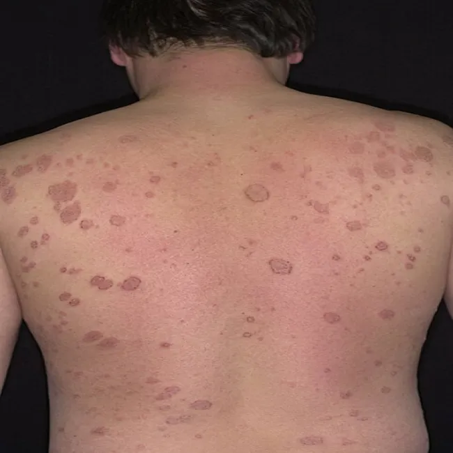 Wyprysk pieniążkowaty na plecach