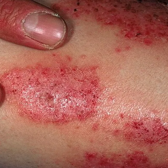 Wyprysk pieniążkowaty 