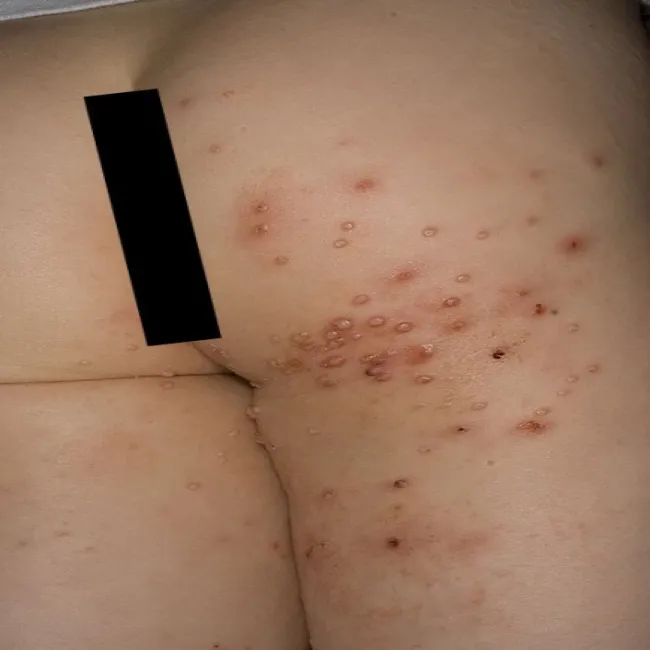 Wypryski grudki na udzie mięczak zakaźny