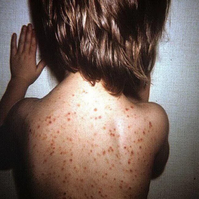 Wypryski na plecach u dzieci przyłuszczyca