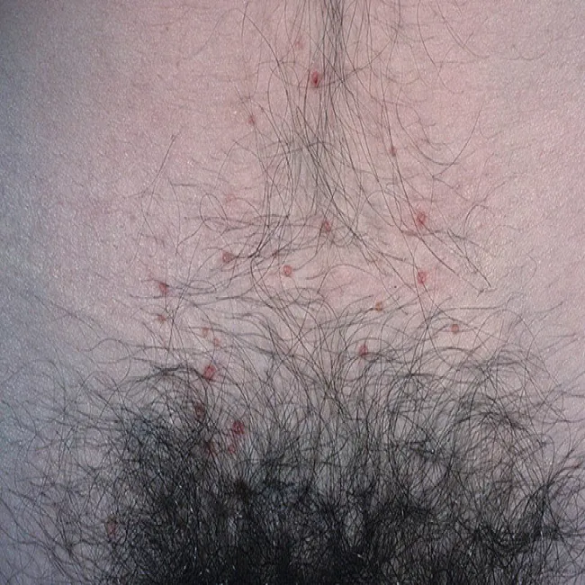 Wypryski na skórze w okolicach intymnych u kobiet