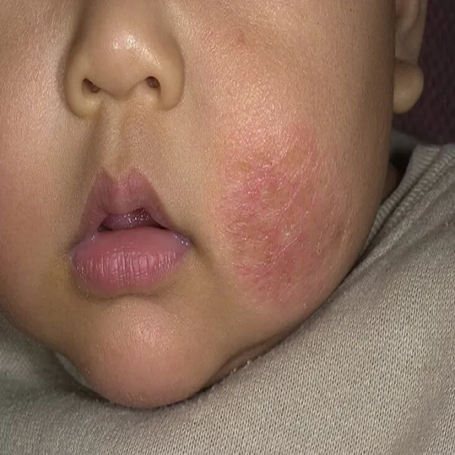 Wypryski na twarzy u dziecka AZS