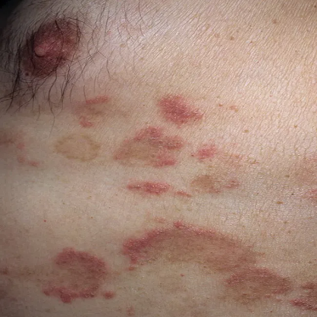 Wysypka alergiczna pokrzywka alergiczna