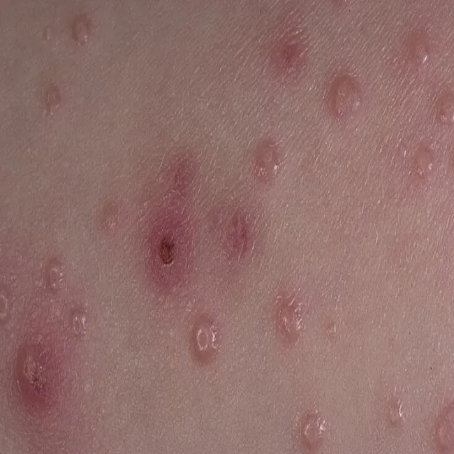 Wysypka czerwone kropki mięczak zakaźny