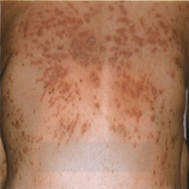 Wysypka grudkowa na plecach choroba Kyrle