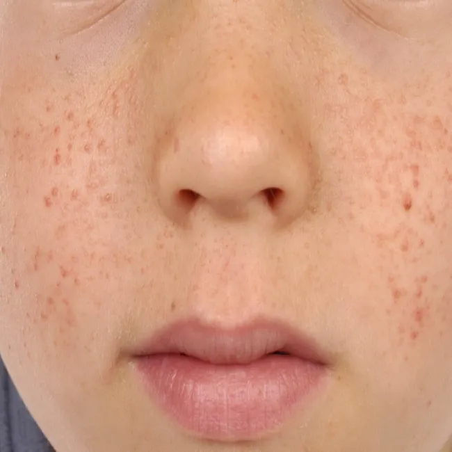 Wysypka guzki na policzkach gruczolak łojowy